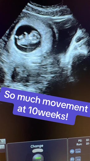10 Weeks Pregnant: Amazing Fetal Movement Insights