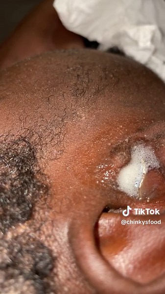 #diy #earcleaning | hydrogen peroxide in ear