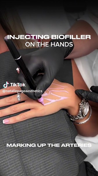 Mastering Biofiller for Hand Rejuvenation: A Guide to Collagen Stimulation