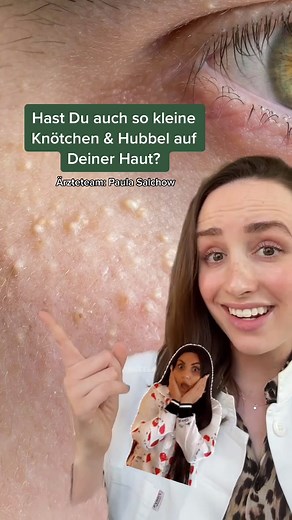 Hautpflege: Milien und Grieskörner entfernen - Geheime Tipps!
