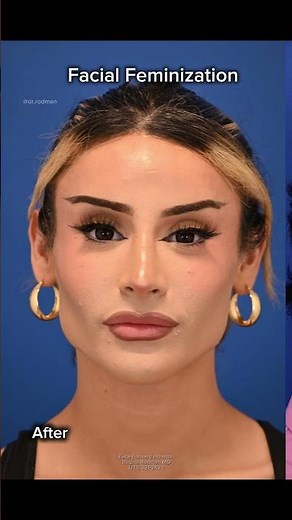 Facial Feminization| Before and After| Plastic Surgery