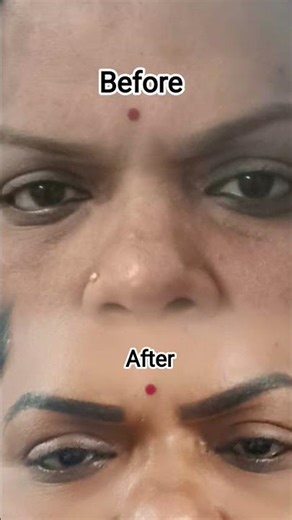 Micro needling service, Sri Gayathri's beauty clinic ( CL road vnb ). #support #love #wedding #best