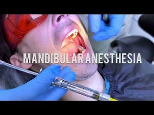 Techniques for Mandibular Anaesthesia , Vazirani-Akinosi Mandibular Block Technique #dentist #dental