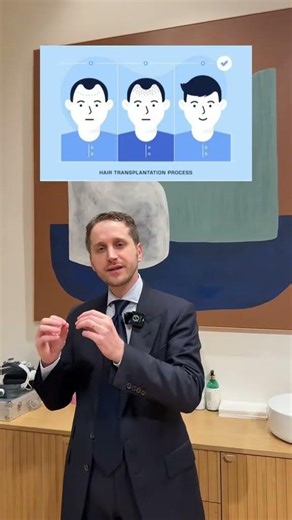 Greffe de cheveux et greffe de barbe. Dr Abbou