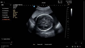 27 Week Baby Ultrasound Measurements Stock Footage Video (100% Royalty-free) 1112056101 | Shutterstock