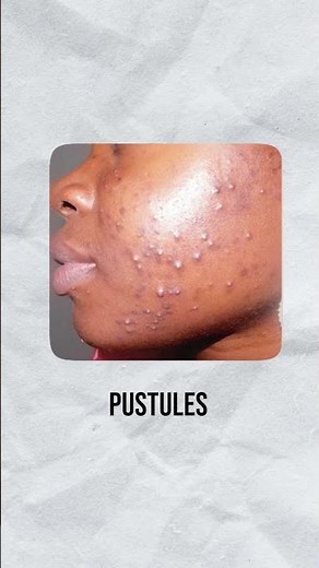 Not All Pimples Are the Same: Here Are the Different Types