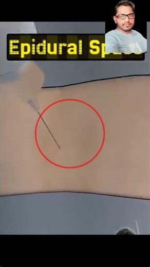 Cesarean Delivery क्या है?#C-Section Delivery कैसे होती है?#Normal vs Cesarean Delivery #shorts