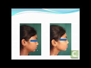 VTO- Visualized Treatment Objective