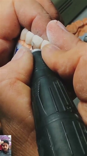 molar ceramic teeth making PFM #ceramic #dentist #dentalhealth #dentistry #art #molars #implant