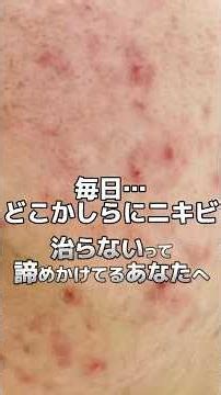 Breakouts Every Day: To Those Who Have Given Up on Clear Skin #Acne #AcneImprovement #Beauty #Ski...