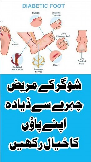 Foot care Tips | Diabetic Foot | Diabetic Neuropathy | Diabetes Management | Diabetes Mellitus