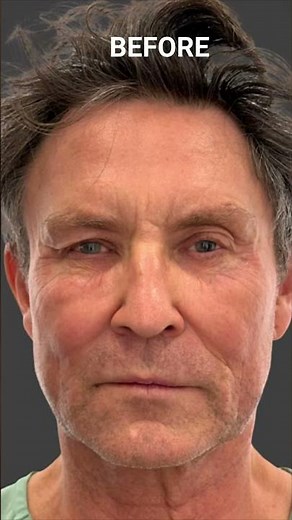 MORPHEUS 8 - INSANE RESULTS AFTER 3 SELF TREATMENTS