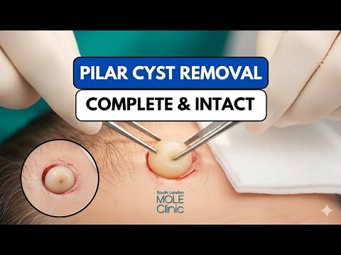 Pilar Cyst Removal