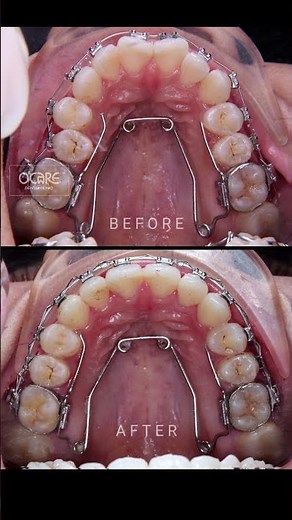 Quad helix orthodontics #braces #orthodontist