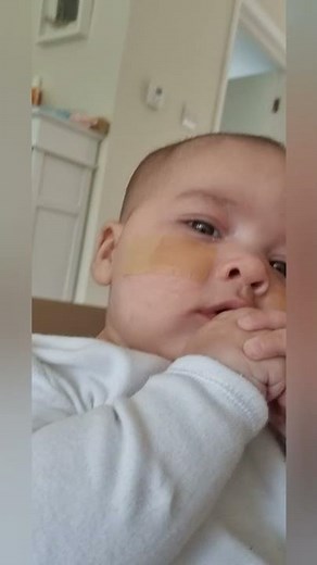 respiratory distress in a 3 month old baby. Grunting, retractions and see-saw breathing