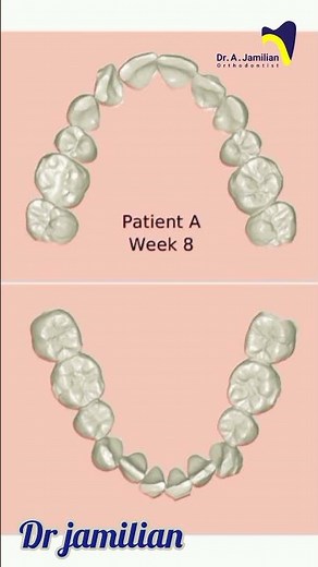 How does the clear aligner work in orthodontics #orthodontics #orthodontist #aligner #invisalign