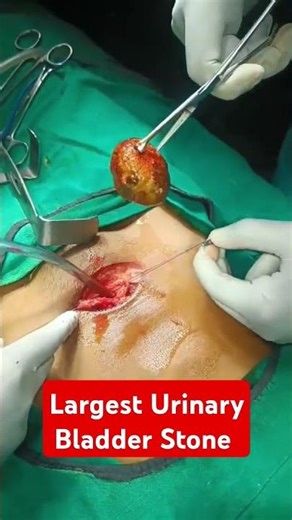 Removing bladder stone-Largest one!❣️❣️#shorts #trending #shortfeed #youtubeshorts #viral #ytshorts