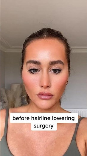Forehead reduction/ hairline lowering surgery transformation #hairlinelowering #foreheadreduction