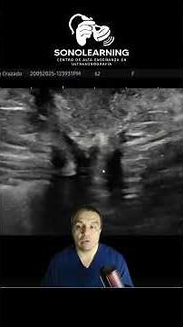 Hernia Umbilical #ultrasound #enseñanza #docencia #cursosonline #hernias #ecografia #ultrasonido