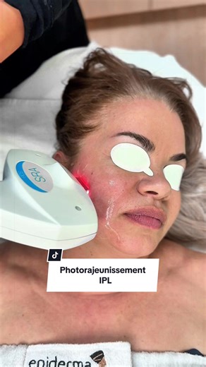 Le photorajeunissement est un traitement non invasif qui aide à améliorer l’uniformité du teint, atténuer les taches pigmentaires, réduire les rougeurs et redonner de l’éclat à la peau. Idéal comme premier soin anti-âge, il permet de prévenir et corriger les signes du temps, sans éviction sociale. Prenez rendez-vous dès maintenant pour une évaluation personnalisée dans votre clinique Medicart ou Epiderma. — Photorejuvenation is a non-invasive treatment that helps improve skin tone uniformity, re