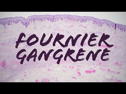 Fournier gangrene: acute necrotic scrotum infection (pathology dermatology dermpath urology)