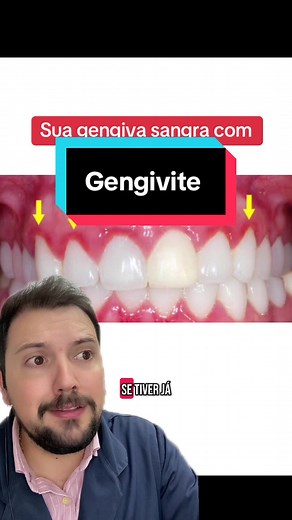 Gengivite: Causas, Sintomas e Prevenção