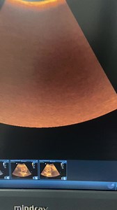 2K views · 27 reactions | Partial molar pregnancy | Doctor Jannat | Facebook