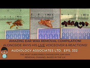 EAR WAX REMOVAL COMPILATION VIDEO - EP 332