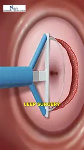 Prolife Cancer Centre & Research Institute on Instagram: "LEEP is a common and effective procedure used to treat cervical precancerous changes. When abnormal cells are detected on the mouth of the uterus the LEEP procedure carefully removes the affected tissue to prevent cervical cancer in the future. If the report confirms that the removed tissue does not contain cancer then most patients do not require any major treatment afterward. LEEP may cause mild pain or light bleeding for a few days but