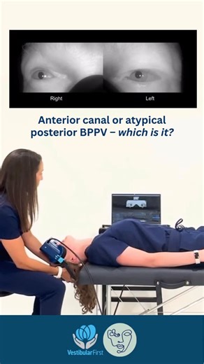 Vestibular First on Instagram: "⏬ 👁️ Have you seen downbeat nystagmus in a straight head hang or Dix-Hallpike test? How do we know if it’s due to anterior canal BPPV, atypical posterior canal BPPV, or a central (brain) issue? 🕵️🫆 Here are some clues to help: 💎✅ To differentiate anterior canal BPPV from atypical posterior canal BPPV, which maneuver clears the BPPV may be our best clue! 1. 👃If the nystagmus responds well (eliminates) after a maneuver with a nose-down position such as the demi