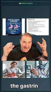 Brunner Gland Hyperplasia Explained Simply for Step 1 | High-Yield Duodenum Pathology Review