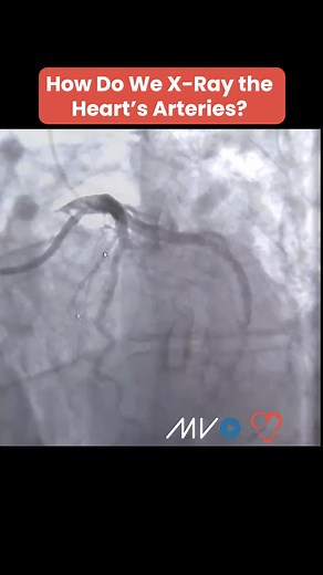 8.3K views · 132 reactions | 嗢 How do we X-ray the heart’s arteries?...