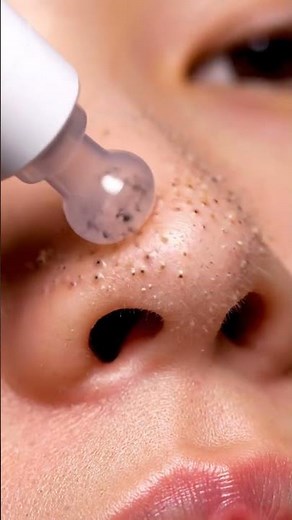 “Nose Vacuum Cleaning That You Can’t Stop Watching!”