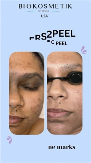 Beauty Peel (B-Peel) & Corrective Peel (C-Peel) #skincare #skincareroutine #training
