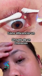 Understanding Orzuelo and Chalazion Treatment Options