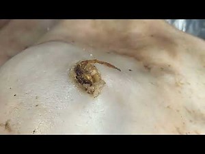 爆大黑頭 | Boogerswax removal |Giant Boogerswax Dr. Geoff pimple popping #Satisfying 0710m2 0506