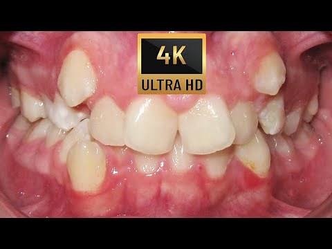 HOW #BRACES WORK - #TIMELAPSE of ECTOPIC CANINES - four premolars extraction case #Orthodontics