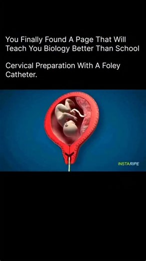 Explaining Biology on Instagram: "Cervical Preparation with a Foley Catheter 🤰🩺 Cervical preparation with a Foley catheter is a mechanical method used to gently help the cervix soften and open (dilate), often before labor induction or certain gynecologic procedures. How it works👇 A small balloon (Foley catheter) is inserted through the cervix and then filled with sterile water. The pressure from the balloon: ✨ Encourages the cervix to open ✨ Triggers the body’s natural release of prostaglandi