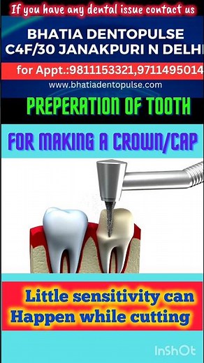 process of capping l cutting of tooth l crown preperation l sensitivity #crownpreperation