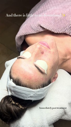 BBL Laser Treatment 💥