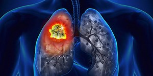 Recent Developments in Lung Cancer Management Explained By An Oncologist
