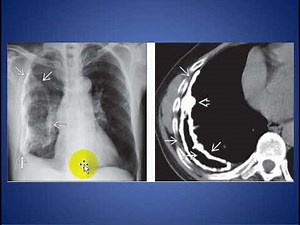 Pleural Calcification