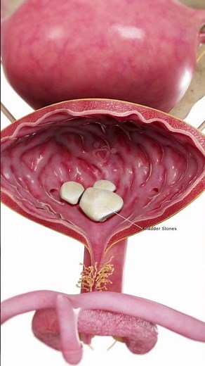 Bladder Stones in 3D | Anatomy Animation