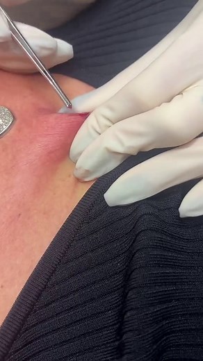 Pose d'un Microdermal : Tendances et Techniques