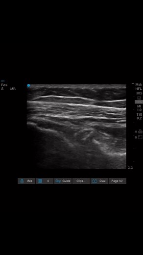 21K views · 213 reactions | Shoulder OA Treatment-intra articular injection. | Wiquar Ahmed | Facebook