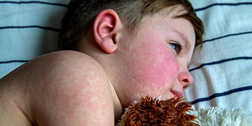 Parvovirus or ‘slapped cheek disease’ is on the rise, CDC warns: Here’s what to know