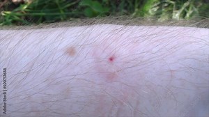 The honey bee stung the beekeeper's hand. Close-up - the site of inflammation from the bite.