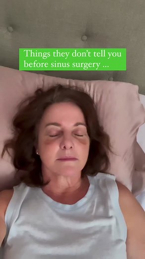 Your sinuses are cavernous… Sometime between the 2nd and 3rd week post sinus surgery, remnants of packing material, blood clots, and tissue that sloughs off the walls of your sinuses can get lodged in the nooks and crannies. You may find yourself waking up to the smell of boiled hot dog water 🌭👃🏼🤢. Regular sinus washing helps, but there’s no escaping the funky smell. It’s all part of the healing process and this too shall pass. #rhinoplasty #septoplasty #sinusplasty #turbinatereductionsurger