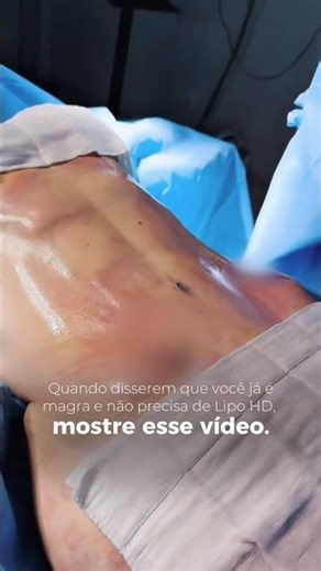 HD LIPOSUCTION ON A THIN WOMAN: Look at this unbelievable before and after! 😱✨