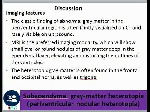 Subependymal gray-matter heterotopia (periventricular nodular heterotopia), febrile seizures
